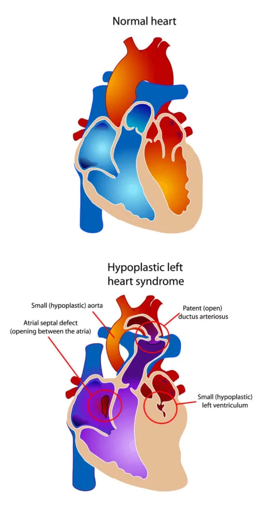 Congenital Heart Disease 1.jpg 1